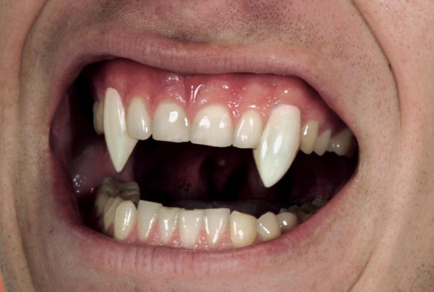 Vampire fangs-fake teeth-teeth veneers-monster teeth